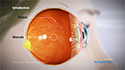 Macular Degeneration