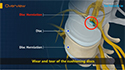 Disc Herniation