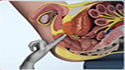 Prostate Biopsy